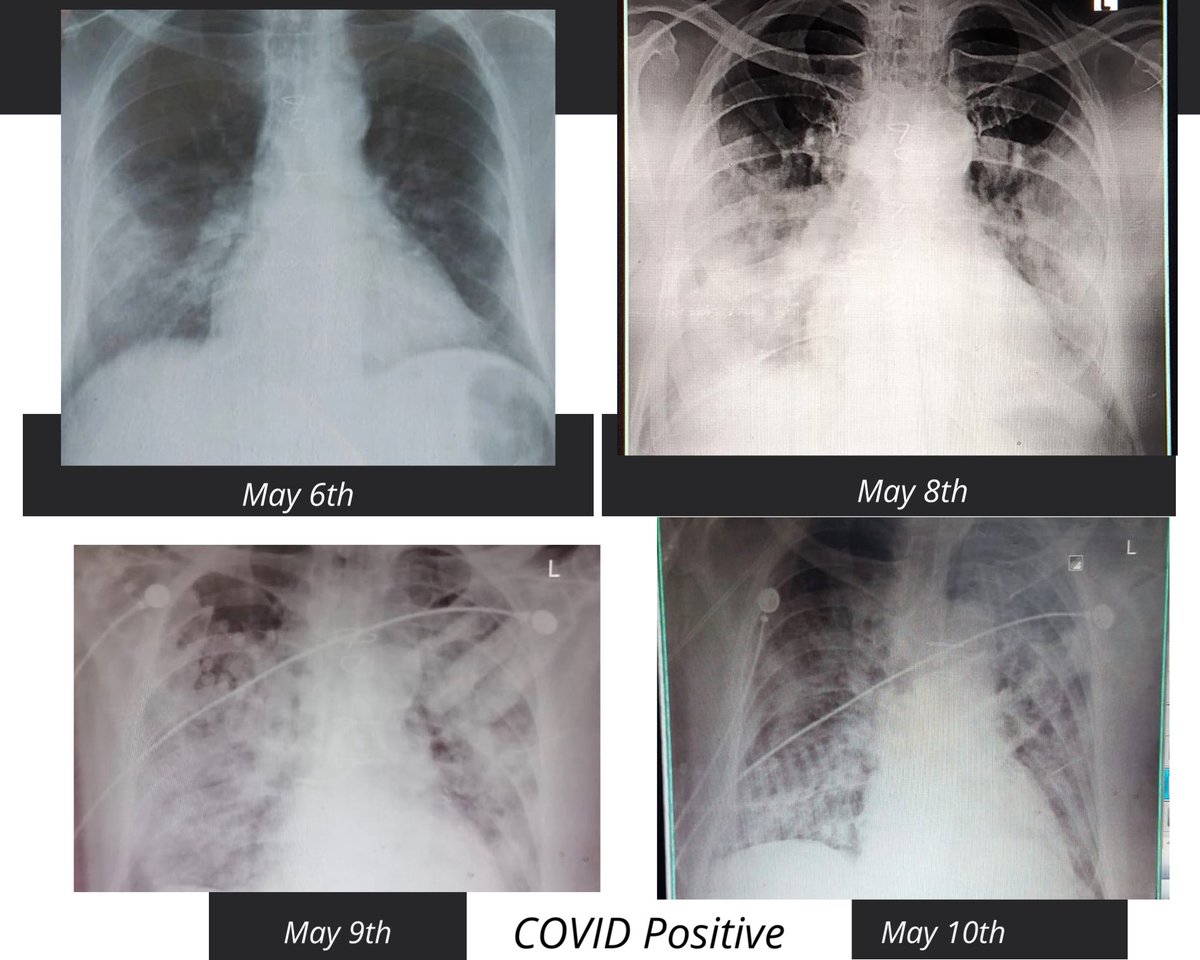DumbestDoc's tweet photo. “The day he was ventilated we weren’t sure if he would make it and prepared for his funeral” said his son 💔😢. Thankfully he recovered!

I was asked by a friend if COVID is a propaganda!
I sent him this patient (relative) chest Xrays

#COVIDIOTS #COVID19 #coronavirus 
#awareness https://t.co/x5EKLrMBIv