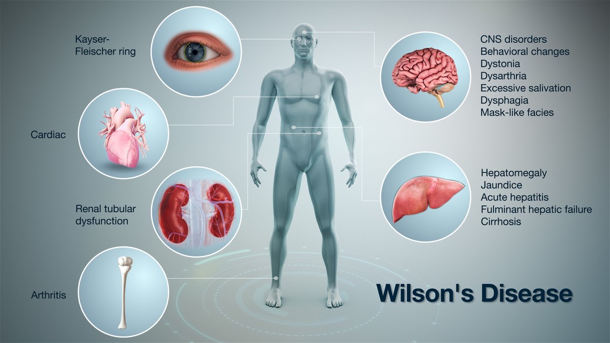 iahealth's tweet photo. Have you ever heard of Wilson's Disease? It deals with a build-up of Copper. Very rare because both parents must have a carrier gene. #healthquestion #health #medicine #wilsonsdisease #copper
https://t.co/hASNoP7OIa https://t.co/tDwk5Lro2a