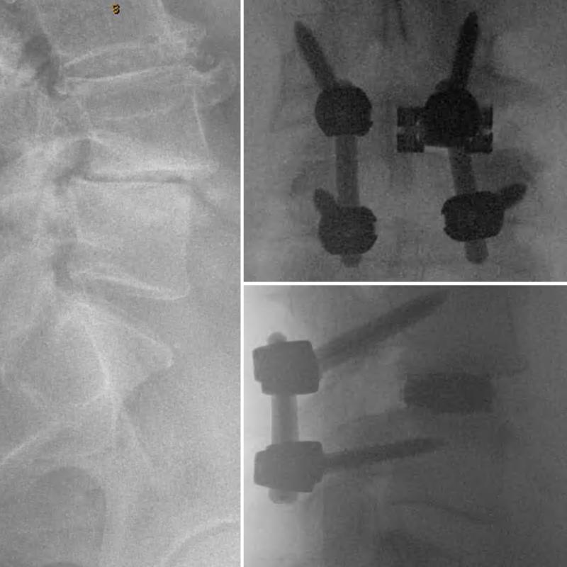 AmplifySurgical's tweet photo. Check out a very impressive pre/post operative difference from Dr. Nima Salari in Scottsdale, AZ utilizing the dualX expandable technology. What an incredible difference!
The dualX continues to provide impressive results! #expandableinterbody #amplifysurgical #dualx https://t.co/qBftQunjgY