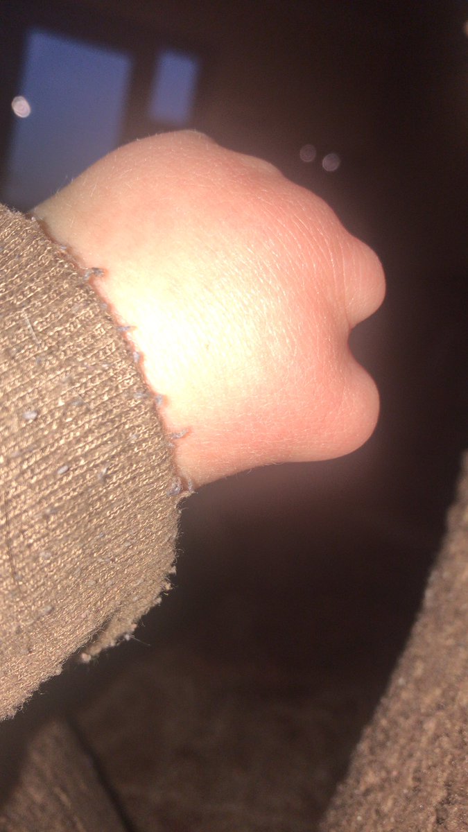 helenthomas76's tweet photo. @LaurenSteadman Hi Lauren, my daughter was born without any fingers on her left hand. She has really enjoyed watching you on @Channel4 #SASWhoDaresWins. She would love to have a “paw” cover. Where do u get your arm cover? #coldpaw https://t.co/wnBxnkqrh8