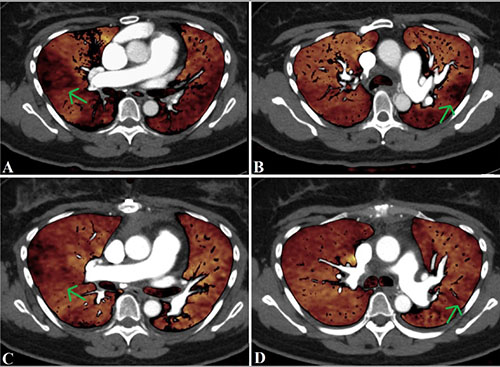 CircImaging (@circimaging) on Twitter photo Dual energy CT for evaluation of CTEPH with V/Q and operative correlation. <a href="/NMCardioVasc/">NM Cardiovascular</a> <a href="/AnandRDesaiMD/">Anand Desai</a> <a href="/ChrisMalaisrie/">S Chris Malaisrie</a> <a href="/SchimmelHeart/">Daniel Schimmel</a> <a href="/venkmurthy/">Venk Murthy MD PhD</a> <a href="/ZainabASamad/">Zainab Samad</a> #AHAJournals
ow.ly/KHQs50zF84n Dual energy CT for evaluation of CTEPH with V/Q and operative correlation. <a href="/NMCardioVasc/">NM Cardiovascular</a> <a href="/AnandRDesaiMD/">Anand Desai</a> <a href="/ChrisMalaisrie/">S Chris Malaisrie</a> <a href="/SchimmelHeart/">Daniel Schimmel</a> <a href="/venkmurthy/">Venk Murthy MD PhD</a> <a href="/ZainabASamad/">Zainab Samad</a> #AHAJournals
ow.ly/KHQs50zF84n