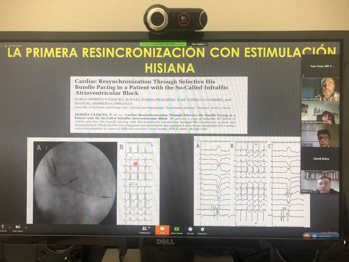 Fantastic lecture on physiologic pacing. Doctor  Pablo Moriña showing the very first case of CRT with His pacing. 👏🏼