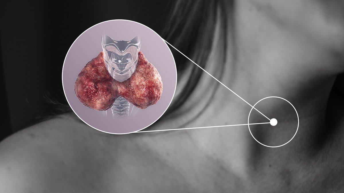 BHRT's tweet image. The Influence of Hormones on Hashimoto's Thyroiditis tinyurl.com/y6uypq53