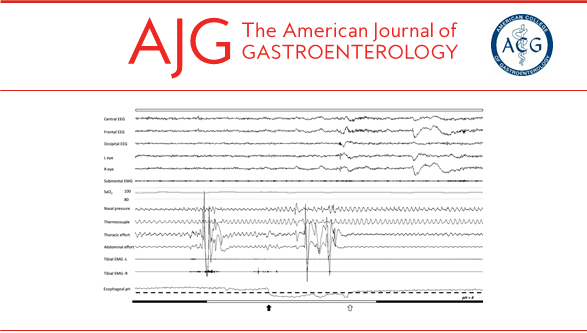AmCollegeGastro's tweet photo. In the AJG "Negative Issue" –
Temporal Relationship Between Night-Time Gastroesophageal Reflux Events and Arousals From Sleep
Shepherd, et al.
👉🏻https://t.co/lZGuivD5AC
#AmJGastro #NegativeIsPositive #GER #SleepHealth @wkhealth https://t.co/QZzSGyJbsq