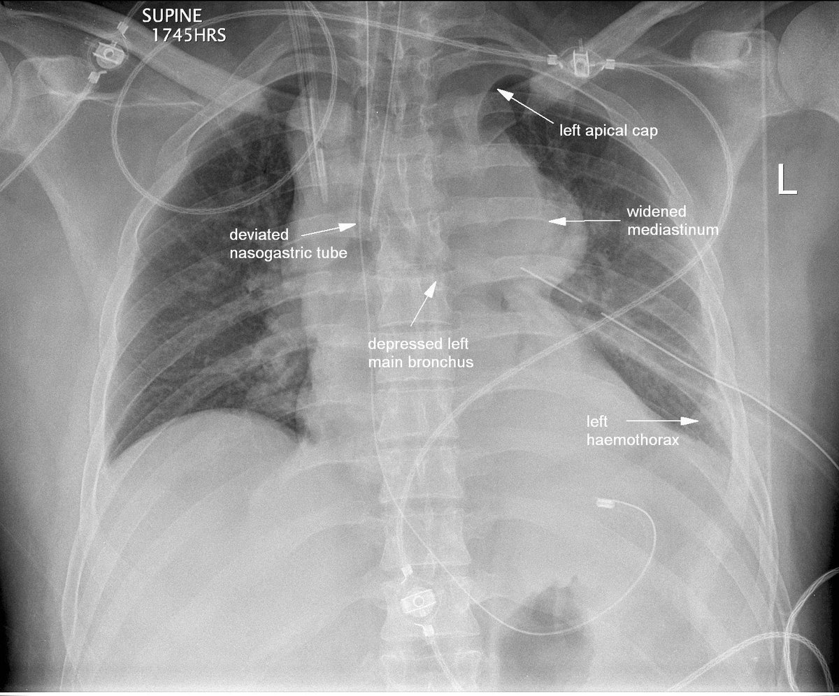 Q.1 similar to the unfortunate scenario I presented, a penetrating left subclavian artery injury; your first step among the mentioned options is getting a chest XRAY. That will guide you then to insert a chest tube or to open the chest immediately. Along with hemodynamic status.
