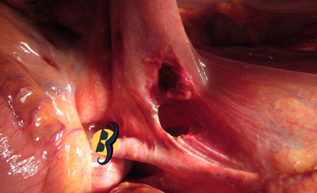 Seat-belt injury, Chance fracture, whiplash injury, acceleration deceleration injury: THINK ABOUT Duodenal perforation and bucket handle bowel injury.Correct answer : duodenal perforation. ( note: the vessel below the perforated DJ junction is the SMA :) )