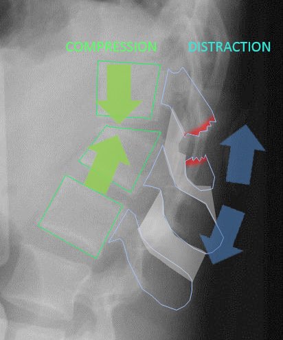 Seat-belt injury, Chance fracture, whiplash injury, acceleration deceleration injury: THINK ABOUT Duodenal perforation and bucket handle bowel injury.Correct answer : duodenal perforation. ( note: the vessel below the perforated DJ junction is the SMA :) )