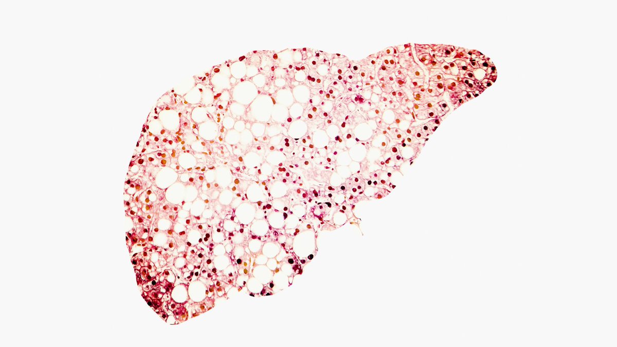 What can patients with  #NASH expect from clinical trials?Recent negative results from  $GILD and now  $GNFT in Phase 3 highlight the uncertainties entering trials that patients faceIs there a minimum potential benefit a patient should accept when entering a trial?THREAD