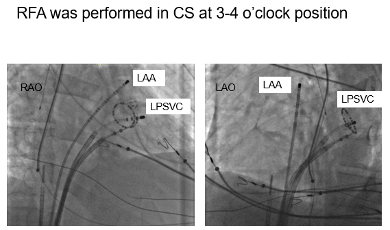 Interesting case of 49 year old M with known persistent left SVC, AVNRT ablation from left posteroseptum , now with paroxysmal Afib. Used 28 mm cryoballoon for PVI. Tried ablating with the balloon in the CS, could not occlude the vein, switched to RFA.