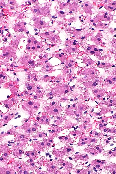 librepathology's tweet photo. With a nod to @Kiril_T_Can - " Low-grade oncocytic #kidneytumor ": CK7 +ve and CD117 -ve; another (evolving) possibility to add to the differential diagnosis of " #renaltumours with eosinophilic cytoplasm " https://t.co/TXfR1Y45oR https://t.co/NqSl7nYazN https://t.co/te3q6B9RKr