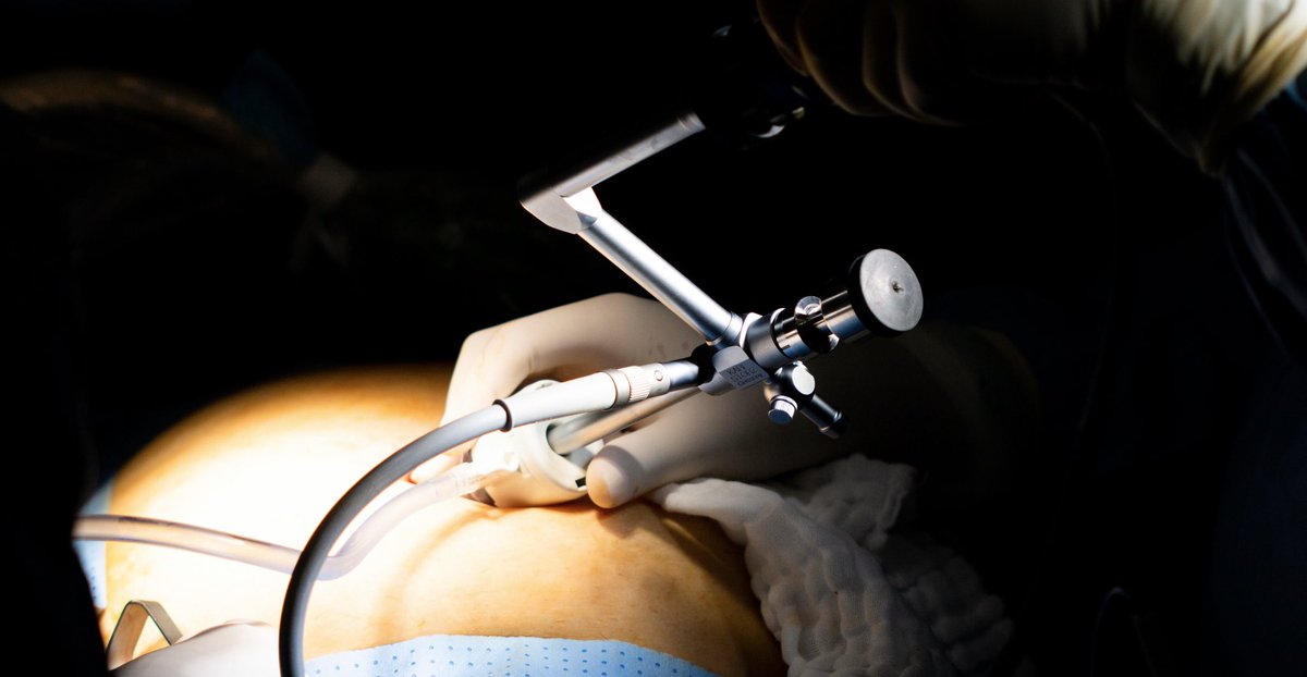 sinhuella's tweet photo. NUEVO VIDEO: Extracción de vesícula biliar por 1 TROCAR UMBILICAL, asistido con imanes #IMANLAP
CIrujano: @zamfrancisco
Diagnóstico: Colecistitis Aguda
Canal de YouTube: EXCELAP
https://t.co/sflY8AX9bP https://t.co/nT3NDm8n5C