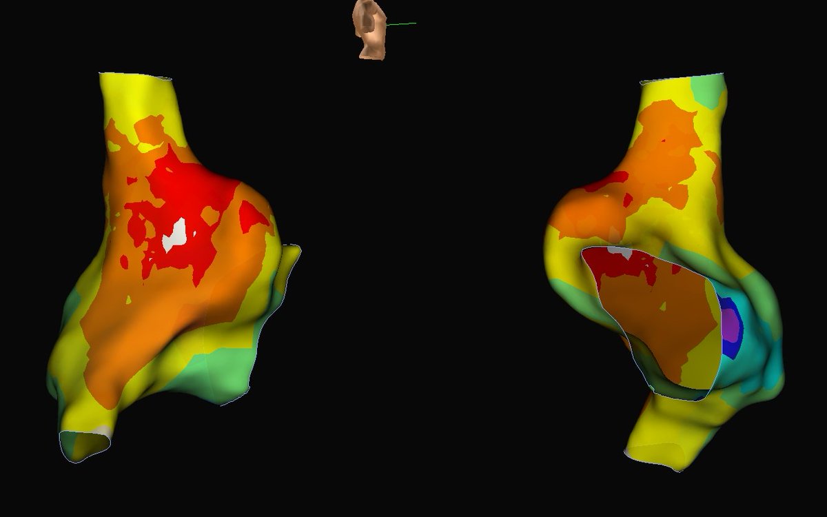 DaneshModi's tweet photo. Incessant SVT ablation last week.  2 focal right atrial ATs.  Nicely mapped by @AbbottCardio @CPaskman.  But check out the CTI geometry!  Massive pouch with huge septal and lateral extensions.  Was going to do an empiric CTI line until this was fully delineated... #EPeeps https://t.co/7zRJHjQPD1