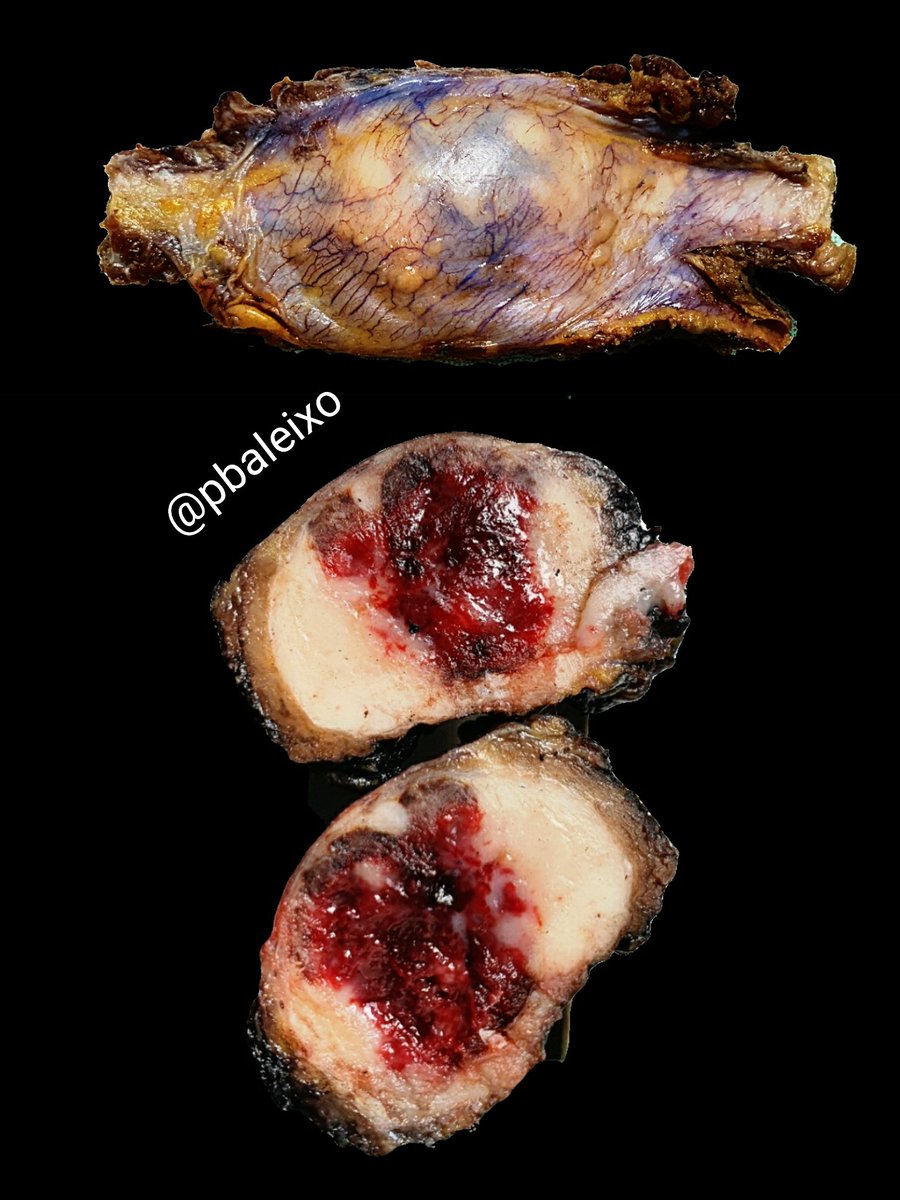 pbaleixo's tweet photo. Solitary plasmacytoma of the rib #bstpath #hemepath #grosspath @UFCSPA_patho @JMGardnerMD @smlungpathguy @ariella8 @edusqo @Patholwalker @ALBoothMD @NRiddleMD https://t.co/rtxOMUjfOK