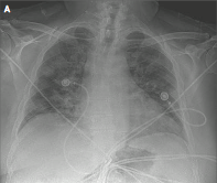  AKI and  #COVID19 68 yo  PMH obesity, HTN, CAD w stent, OSA, T2DM ED w SOB + fever 39.9°C. Poor oral intakeRR 40, Sat 94% Room Air, BP 157/74 HR 124. Alert. Bibasilar cracklesLabs: Cr 1.3 (baseline 0.8), WBC 10, K 5.4, HCO3 17, CK 184. UA and CXR (case from  @NEJM)