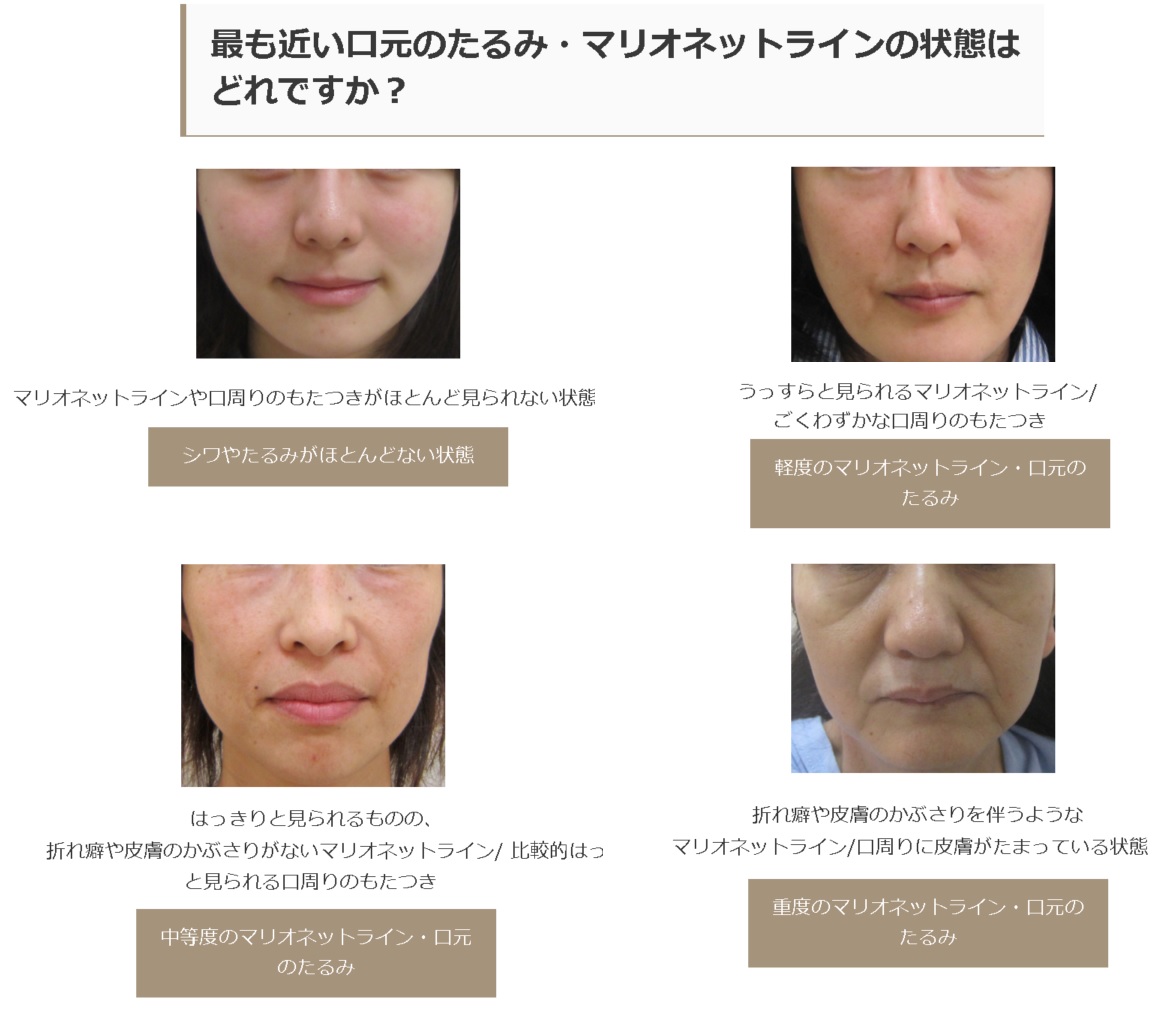 口元 たるみ 口元 たるみ