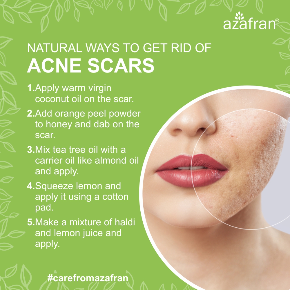 Azafran_IN's tweet photo. One can treat #acne using the #products available commonly. Good #basic #skin #regimens can help with the #acne battle.#homeremedy #regime #carefromazafran #iloveazafran #azafran #summer #skincare #gonatural #herbal #natural #godesi #inthistogether #beauty #bebeautiful #beyou https://t.co/VVmIy979FN