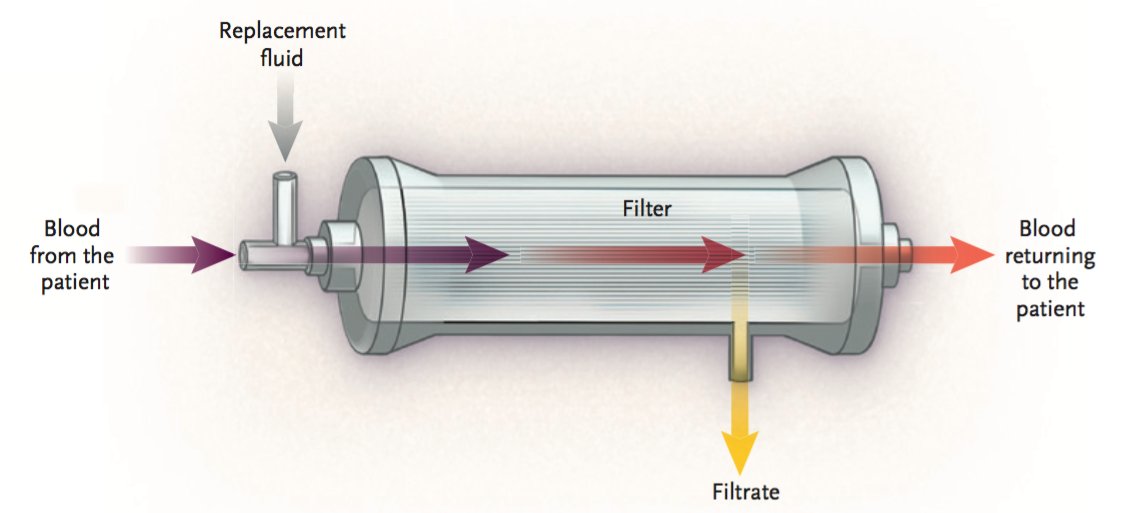 This patient was actually given 2 L IV fluid with no improvement on kidney function. Eventually required RRT with CRRT. Given I know nothing about CRRT, I hope my good friend  @galindozip can complement this thread with his awesome knowledge!