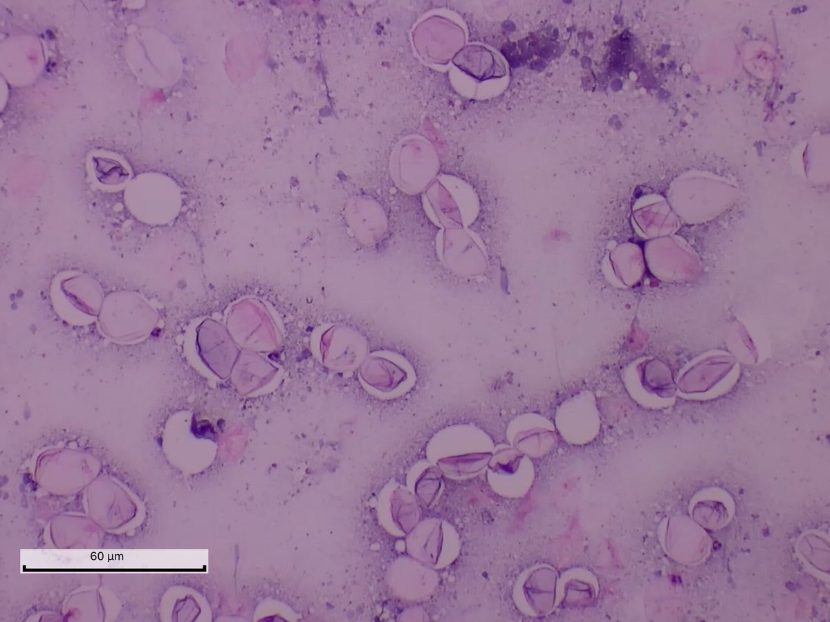ReyPathology's tweet photo. FNA of nodule in parotid gland. Help https://t.co/lO3P2laIyX