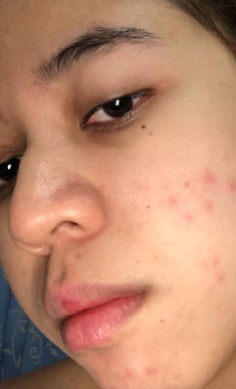 Sheikaempire's tweet photo. MY SKIN JOURNEY 
I’ve tried most local skincare dulu. Tabit*, dm* 360, tat*, and so much more. Flawless mcm telur kulit i okay. Putih tu mmg putih gila! Seronok lah. I realised that if i stop a week, dia naik. Then pkai, flawless balik. Tak ke pelik tu? https://t.co/Pwq1MrqEOj