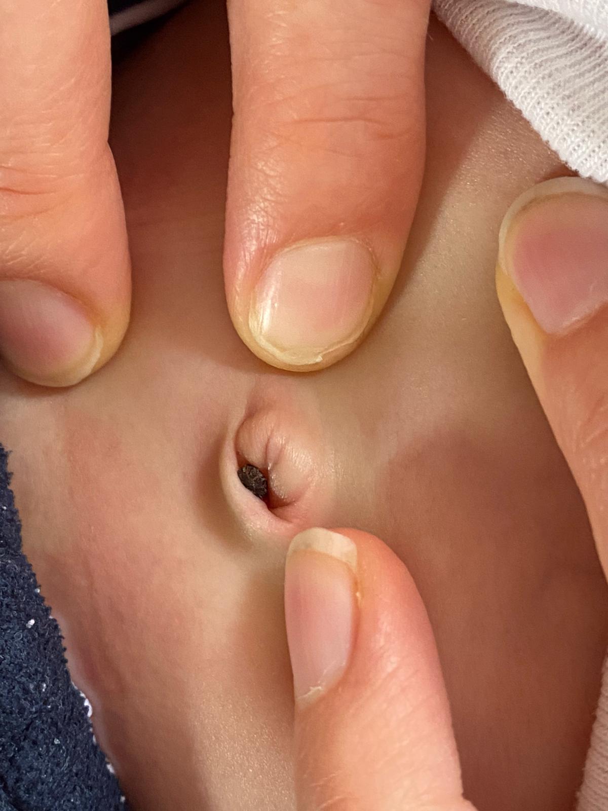 Bourgeon Nombril Bebe Nitrate D Argent