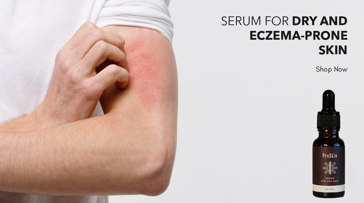 dermedco's tweet photo. Are you going through Itchy Eczema? And couldn’t you find any solution till now? 
We are here to help you. Proskin Serum is one solution that you can order by sitting home. 

#proskin #eczemarelief  #eczemahelp #eczemacare https://t.co/rf6vVFIm0l