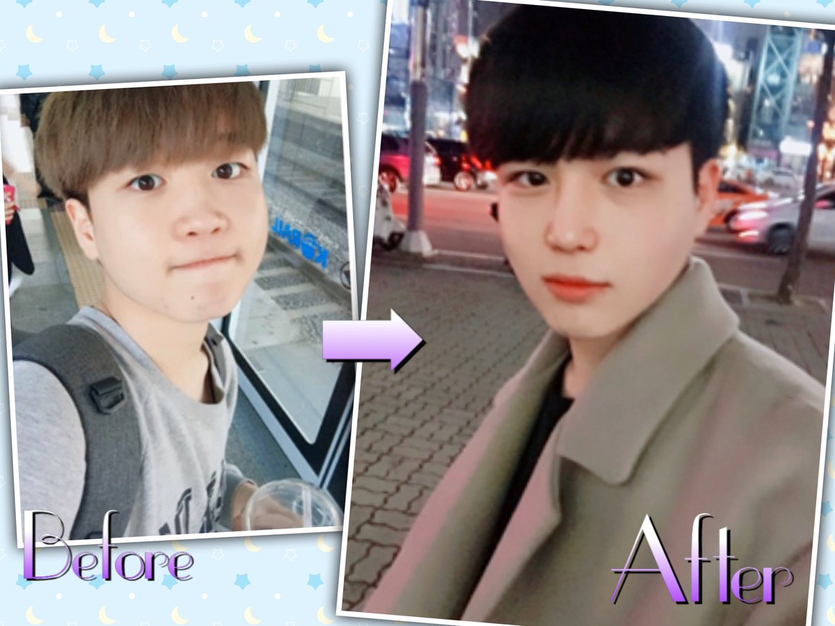 韓国美容観光エージェンシーharu 日本人モニターの整形でも有名な Id美容外科 の 男性整形 幼顔の男子から都会の 男性へ 頬骨縮小 Vロジック顎手術 自然癒着埋没 鼻整形 男性の方もお気軽にlineへご連絡下さい T Co Lhidcwcvdc ブログも