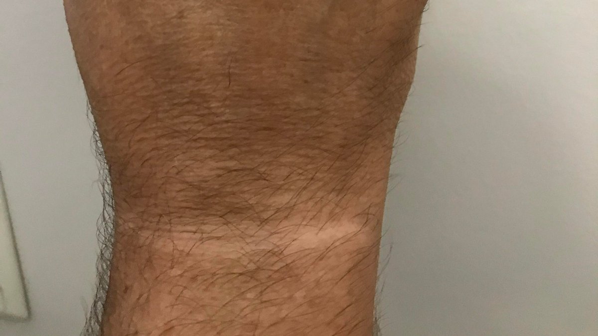 drj1992's tweet photo. I've been riding my bike so much that I've developed a line on my wrist that doesn't get sun because of my position on the handlebars!  At first I wondered what kind of strange condition I had! https://t.co/KEVvtdnN0m
