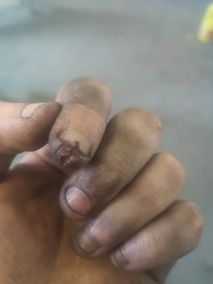 This what happens when you catch your finger with a grinder 😂