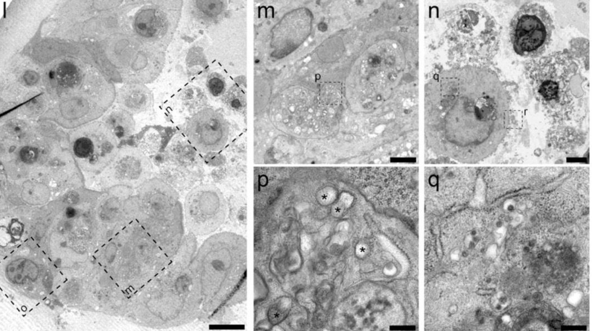 Immunopole's tweet photo. By combining #SmallIntestinal #Organoids #ElectronMicrosopy #ConfocalMicroscopy & mRNA expression analysis @HansClevers et al. @ErasmusMC @MaastrichtU help to better understand why some #COVID19 patients develop #GastrointestinalSymptoms @ScienceMagazine https://t.co/lotV3FNGxc https://t.co/YU1xSrw8nc
