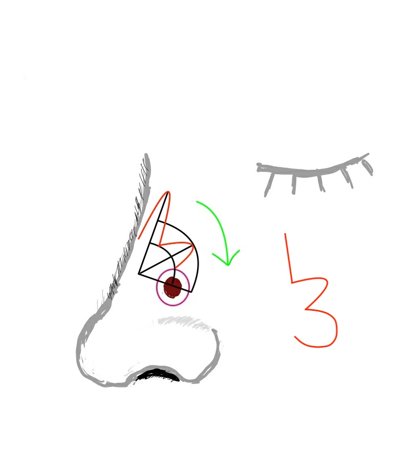 1brahim_1brahim's tweet photo. @MedSyncLtd @dheansa_plastic @bjemec @MrPKalu @Kavit_Amin @weesim_ My favourite time of the week (in #Lockdown ๐) @MedSyncLtd #ReconChallenge! Zitelliโs bilobed modification is my preference (โ๐พbut a FTSG could also work a treat!) #TweeConstructiveChallenge #CutShapes ๐บ๐พ https://t.co/92PksRHvwW