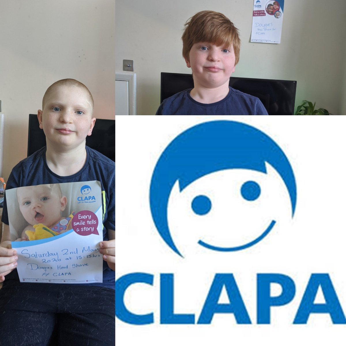 Dougie has done the head shaved please donate what you can. #CLAPA #behindeverysmile #Cleftaware