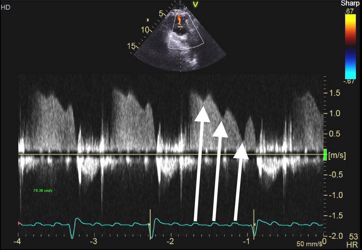 Carlos El-Tallawi, MD โHeartToProveโ (@hearttoprove) on Twitter photo ๐๐ฎ๐ฅ๐ฆ๐จ๐ง๐๐ซ๐ฒ ๐ซ๐๐ ๐ฎ๐ซ๐ ๐ข๐ญ๐๐ญ๐ข๐จ๐ง ๐ฃ๐๐ญ ๐ข๐ง๐ญ๐๐ซ๐ซ๐ฎ๐ฉ๐ญ๐๐ ๐๐ฒ ๐๐ญ๐ซ๐ข๐๐ฅ ๐๐ฅ๐ฎ๐ญ๐ญ๐๐ซ ๐ข๐ง๐๐ฎ๐๐๐ ๐๐ ๐ค๐ข๐๐ค๐ฌ:
๐๐ ๐๐จ๐ง๐ญ๐ซ๐๐๐ญ๐ข๐จ๐งโ>โฌ๏ธ๐๐ ๐ฉ๐ซ๐๐ฌ๐ฌ๐ฎ๐ซ๐โ>โฌ๏ธ๐๐-๐๐ ๐๐ข๐๐ฌ๐ญ๐จ๐ฅ๐ข๐ ๐ ๐ซ๐๐๐ข๐๐ง๐ญโ>๐๐ง๐ญ๐๐ซ๐ซ๐ฎ๐ฉ๐ญ๐๐ ๐๐ ๐ฃ๐๐ญ. ๐๐ฎ๐ฅ๐ฆ๐จ๐ง๐๐ซ๐ฒ ๐ซ๐๐ ๐ฎ๐ซ๐ ๐ข๐ญ๐๐ญ๐ข๐จ๐ง ๐ฃ๐๐ญ ๐ข๐ง๐ญ๐๐ซ๐ซ๐ฎ๐ฉ๐ญ๐๐ ๐๐ฒ ๐๐ญ๐ซ๐ข๐๐ฅ ๐๐ฅ๐ฎ๐ญ๐ญ๐๐ซ ๐ข๐ง๐๐ฎ๐๐๐ ๐๐ ๐ค๐ข๐๐ค๐ฌ:
๐๐ ๐๐จ๐ง๐ญ๐ซ๐๐๐ญ๐ข๐จ๐งโ>โฌ๏ธ๐๐ ๐ฉ๐ซ๐๐ฌ๐ฌ๐ฎ๐ซ๐โ>โฌ๏ธ๐๐-๐๐ ๐๐ข๐๐ฌ๐ญ๐จ๐ฅ๐ข๐ ๐ ๐ซ๐๐๐ข๐๐ง๐ญโ>๐๐ง๐ญ๐๐ซ๐ซ๐ฎ๐ฉ๐ญ๐๐ ๐๐ ๐ฃ๐๐ญ.