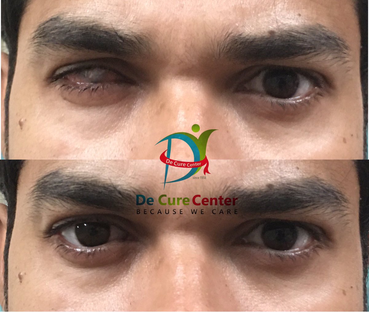 Get ur best prosthetic eye done only at de cure Center 

#Artificialeye #prostheticeye #artificialeyeservices #bestprostheticeyecenter