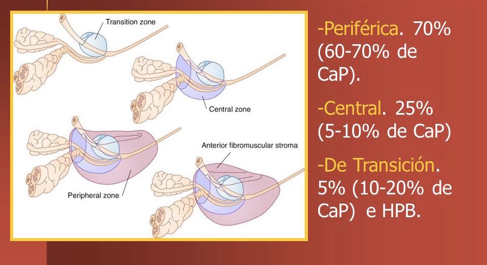 Cancer prostata zona periferica. Cancerul de Prostata()