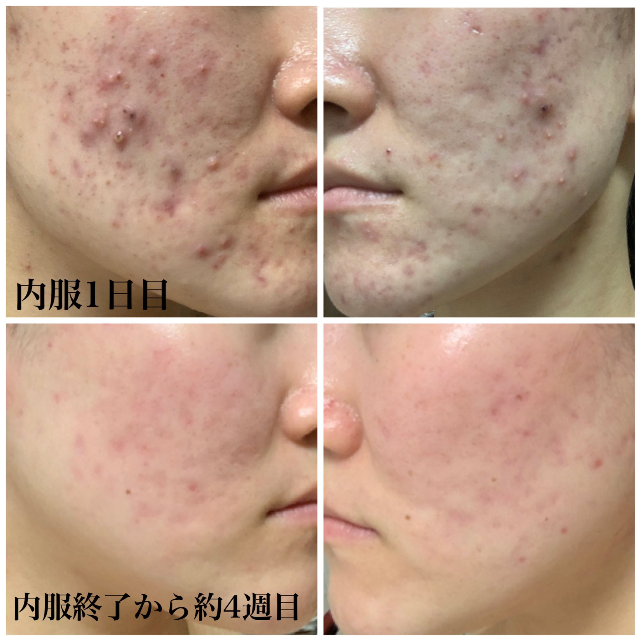 ニキビ治療日記はちみつ Acnediary Honey Twitter