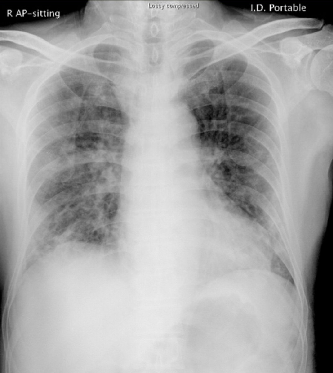 Here is an AI based system which can detect the presence of COVID-19, Pneumonia and if a person is at normal condition using an X-ray images.

jovian.ml/zreuben815/res…

 #PyTorch #Resnet18 #Django #DL #CNN #COVID_19Tz