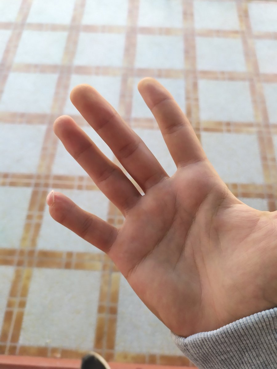 edubuye's tweet photo. Me corté el dedo meñique con 4 años y creía que con el tiempo iba a volver a su forma normal porque el médico me dijo que con 20 años ese dedo iba a ser como el de mi otra mano. Tengo 20 años. Me acabo de hacer la foto. https://t.co/443el23Efc