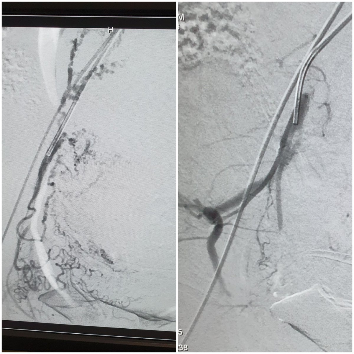 #irad is about opening up some vessels (like the ICA + MCA occlusions in stroke patient treated with solumbra) and closing others (PPH post LSCS treated with uterine artery embolisation). #withoutascalpel #solumbra #tandemocclusion #UAE #PPH