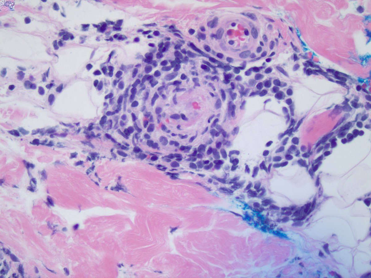 JMGardnerMD's tweet photo. "COVID toes": Pernio-like red to violaceous toe lesions associated w #COVID19. On this biopsy: ischemic epidermal change, superficial &amp; deep perivascular infiltrate, luminal thrombi. Case via Sigal et al: https://t.co/4XQRqijIeY #dermpath #dermatology #dermtwitter #pathology https://t.co/kuaJYw0FC3