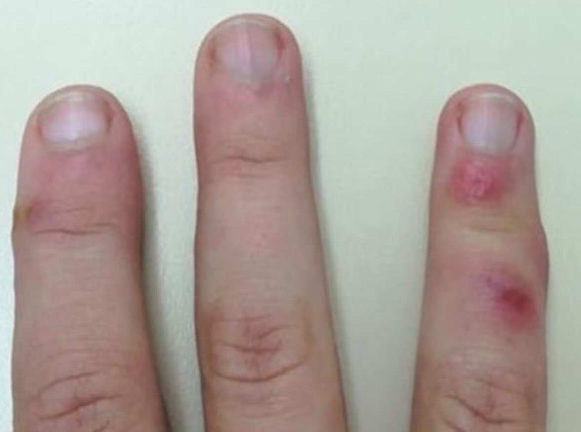 doctormacias's tweet photo. La perniosis o “sabañones” son protuberancias en la piel que se producen por la exposición a temperaturas bajas, pero ahora se han encontrado en algunos pacientes con Covid-19 (Br J Dermatol: Abril 19,2020) https://t.co/MXc9RY2PJO