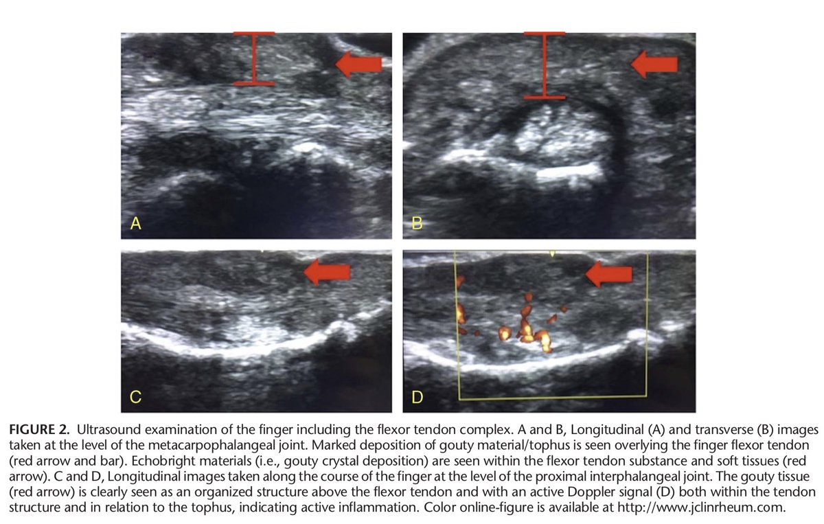 JRheumatology's tweet photo. When #Gout #Mimicks #Infection!
#rheum #rheumatology #crystallopathy
https://t.co/vNwci922jO https://t.co/f5c1bCbAMP