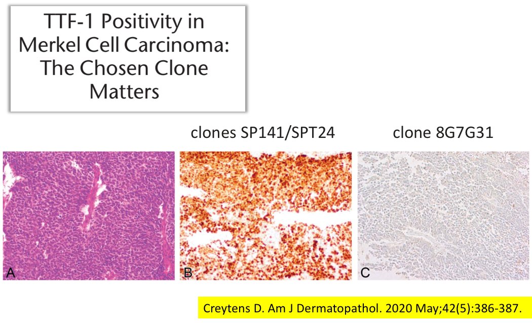 kis_lorand's tweet photo. Antibody clone-dependent TTF-1 positivity described in a case of Merkel cell carcinoma 😱 
I thought of @smlungpathguy  when I read this 🤣😁🤣
#dermpath #IHCpath #pathology https://t.co/6qfiR26szV