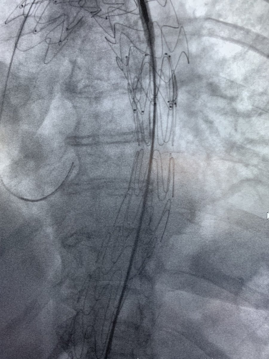 VascSurgMD's tweet photo. TBAD with persistent pain despite controlled BP and pain/anti inflam meds.  Note the bovine arch and healthy left Vert off the arch.  How long do YOU wait with persistent pain? #petticoat @VascularMD  @GChadHughesMD @RKTvascular  @DrAliAzizzadeh @AorticCenter @BruceTjadenMD https://t.co/hxBqGZE2xv