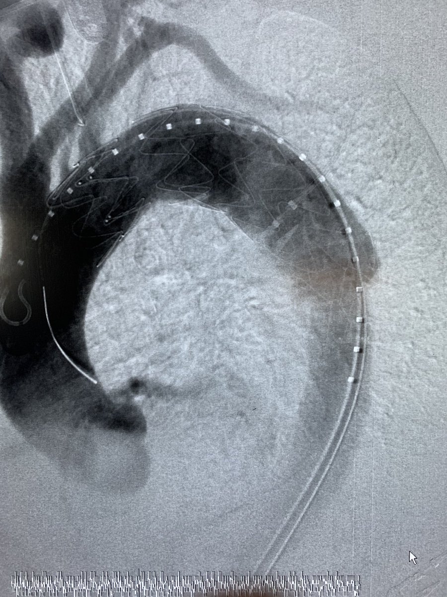 VascSurgMD's tweet photo. TBAD with persistent pain despite controlled BP and pain/anti inflam meds.  Note the bovine arch and healthy left Vert off the arch.  How long do YOU wait with persistent pain? #petticoat @VascularMD  @GChadHughesMD @RKTvascular  @DrAliAzizzadeh @AorticCenter @BruceTjadenMD https://t.co/hxBqGZE2xv