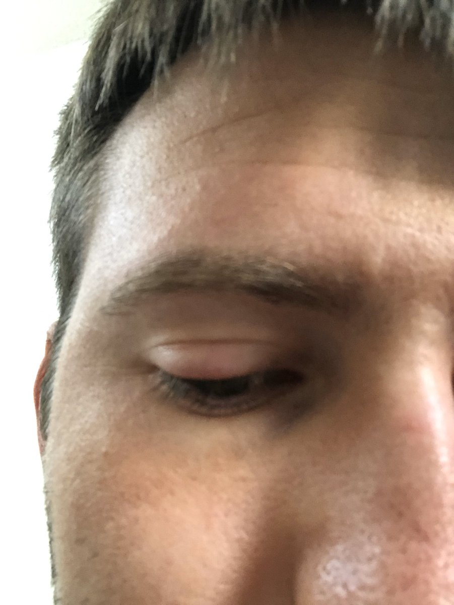 yaboidaniel66's tweet photo. Bringing back #Danielism. Danielism #7: don’t use a pen to draw a fake scar on your eye. You will wake up with a swollen eyelid https://t.co/bD4TkEgYyn