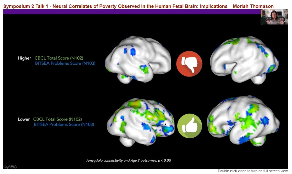 CogNeuroNews's tweet photo. Looked at Detroit-based longitudinal from prenatal up - oldest now 6 years old -- to see which patterns of amygdala connectivity are associated with better or worse outcomes https://t.co/wJPrfOvkxy