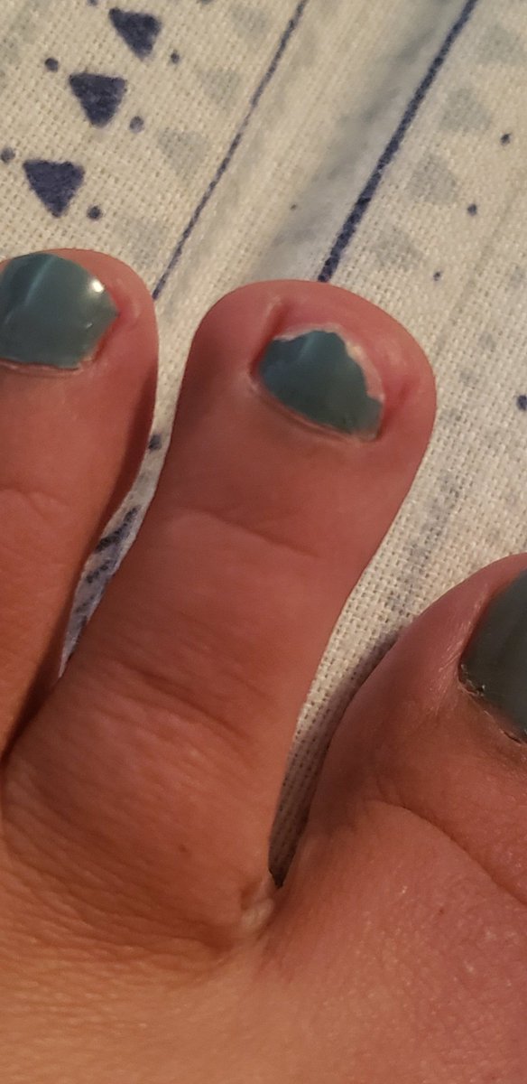 size7cutie's tweet photo. I'M BACK FROM THE WILDERNESS.
There was a little sun, a little hail, LOTS of rain and wind strong enough to break our popup canopy. I survived, my toenail didn't.
#brokeanail #camping #badweather #feetpics #fetish #pedineeded https://t.co/rBHcfP90RK