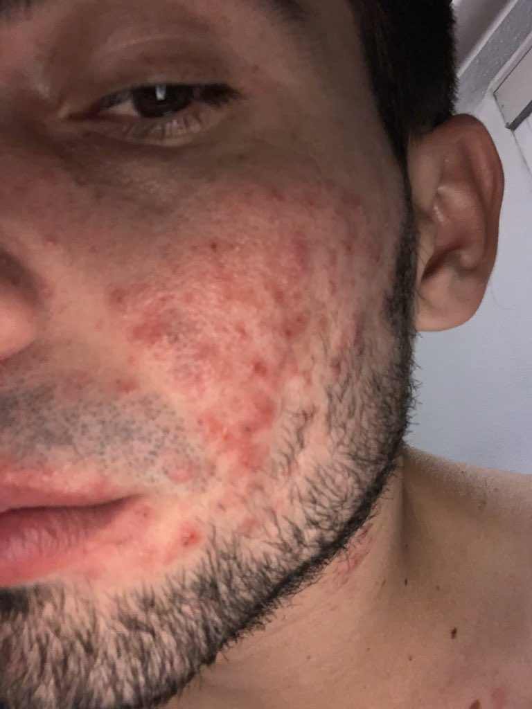 robertolucich's tweet photo. Normalicemos el Acné. 

Expongo mis complejos y no se imaginan lo difícil que es subir este tipo de fotos. https://t.co/GCrYwg3iXY