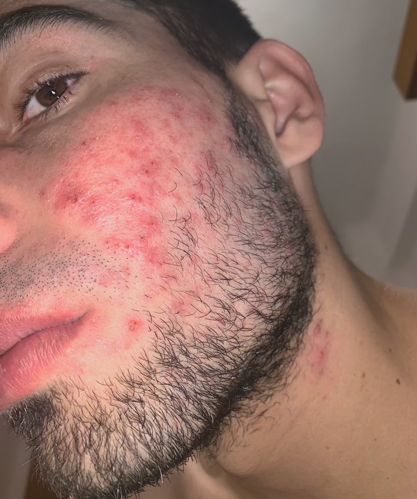 robertolucich's tweet photo. Normalicemos el Acné. 

Expongo mis complejos y no se imaginan lo difícil que es subir este tipo de fotos. https://t.co/GCrYwg3iXY