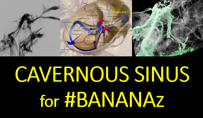 neuroangio1's tweet photo. See you all -- Tuesday 8 am NY time -- as usual. #BANANAz Topic: #cavernoussinus Go to https://t.co/0MhQKhQcz6 and click on the link. https://t.co/RselhcJMkZ